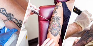 Tattoo Removal: Options and Results tattoo removal