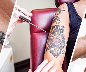 tattoo removal