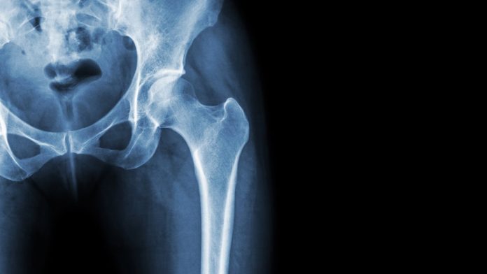 Bone health goes beyond just calcium, studies show